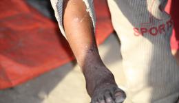 Drei Geschwister einer Familie leiden unter Krätze. Dieser Junge hat den Ausschlag am Unterschenkel, ... Drei Geschwister einer Familie leiden unter Krätze. Dieser Junge hat den Ausschlag am Unterschenkel, ...