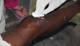 Obwohl der Bruch bereits am Verheilen ist, verursacht Flüssigkeit im angeschwollenen Kniegelenk starke Schmerzen. Obwohl der Bruch bereits am Verheilen ist, verursacht Flüssigkeit im angeschwollenen Kniegelenk starke Schmerzen.