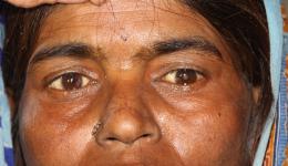 Auf ihrem linken Auge kann man den Schleier des grauen Stars noch erkennen. Auch dieses Auge soll demnächst in der Agenklinik operiert werden.