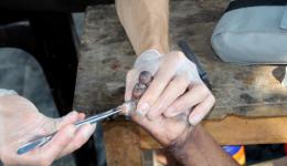 Durch eine, chronisch den Finger zerstörende, Infektion, entstehen oft diese dauerhaft völlig funktionslosen Hände von Leprabetroffenen. Hier muss ein bereits abgestorbenes Endglied entfernt werden.